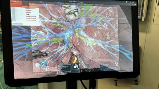 Lung cancer surgery with augmented reality